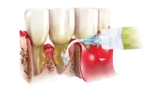 Perio-Flush / 10 x 3 ml