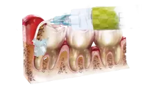 Perio-Flush / 10 x 3ml