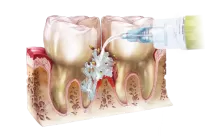Perio-Flush / 10 x 3ml