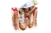 Perio-Flush / 3ml