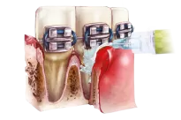 Perio-Flush / 3ml