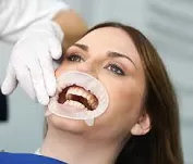 OptraGate® 2 / rozwieracz jamy ustnej / 1 szt.